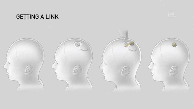 Neuralink : un patient dit « I love you » à sa femme grâce à sa voix reconstruite
